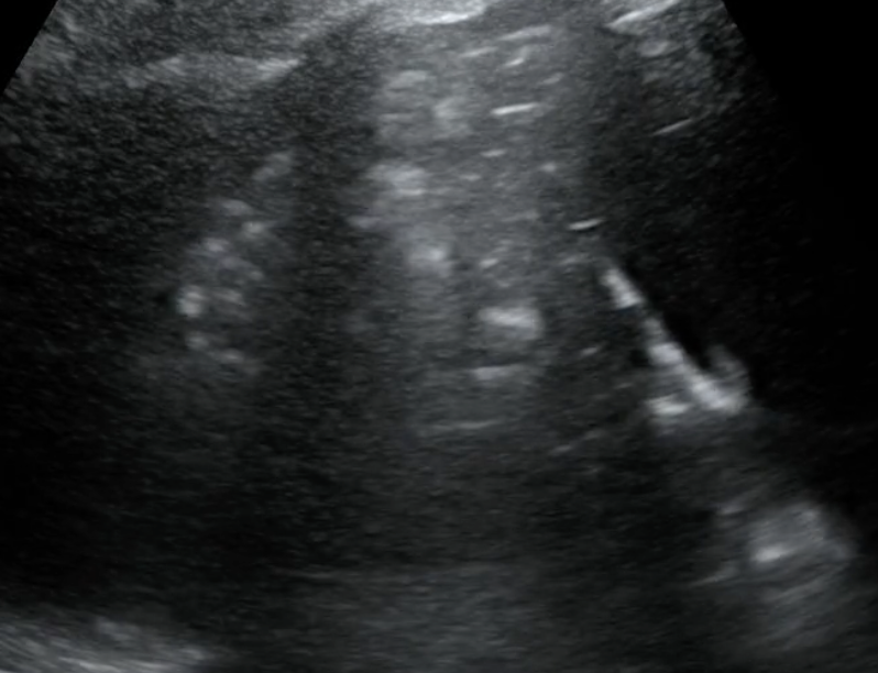 Depiction of air bronchograms in consolidated lung