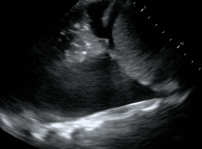 Spine sign with consolidated lung