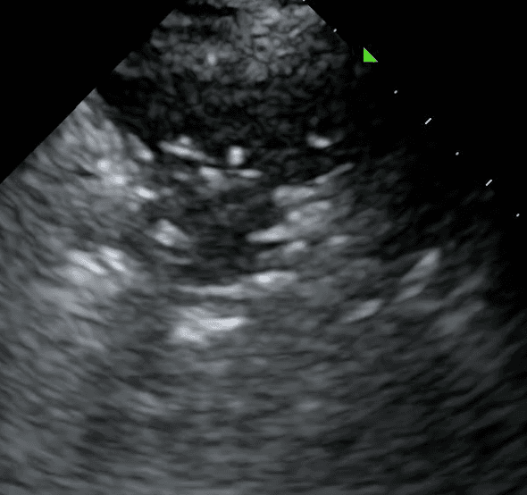 Shred sign seen at the border between normal and abnormal lung 