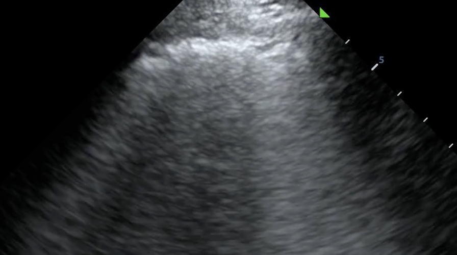 Thick, irregular pleural line with associated B lines