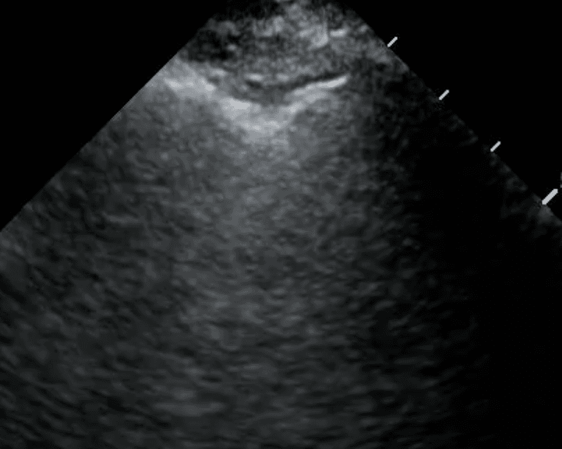  A subpleural nodule appears as a dark round structure underneath the pleural line 