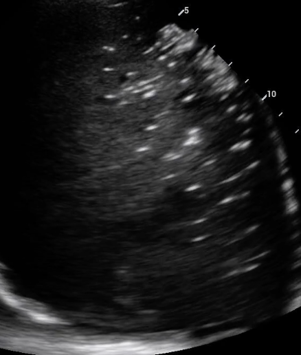 2-Dimensional image of a lung consolidation