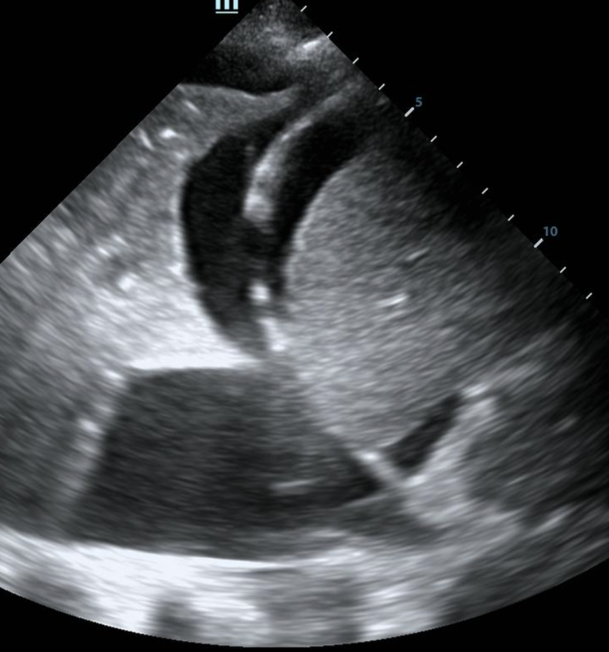 Ultrasound image of the interphase between the lung, diaphragm and spleen