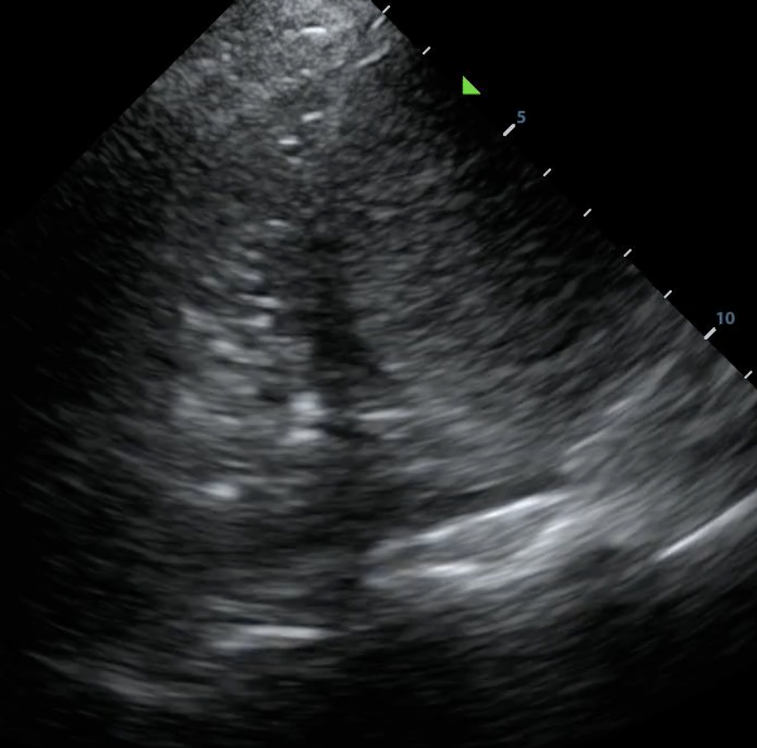 Small pleural effusion