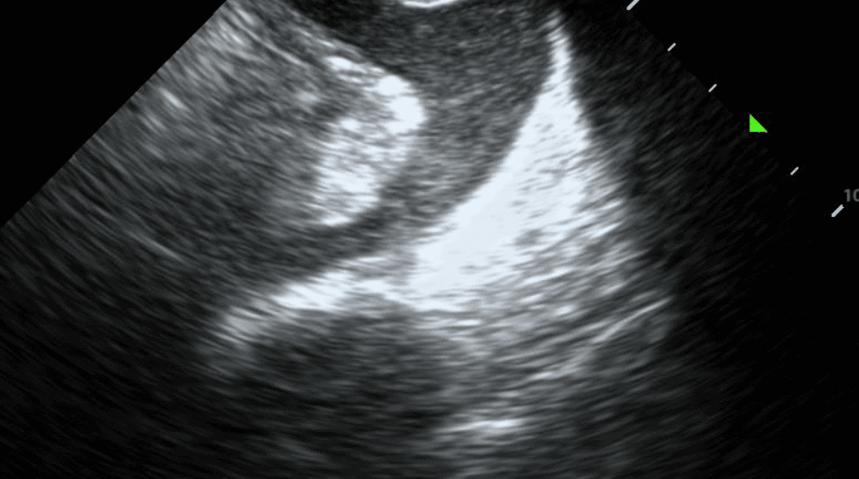 Complex pleural effusion