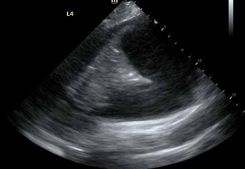 Simple pleural effusion