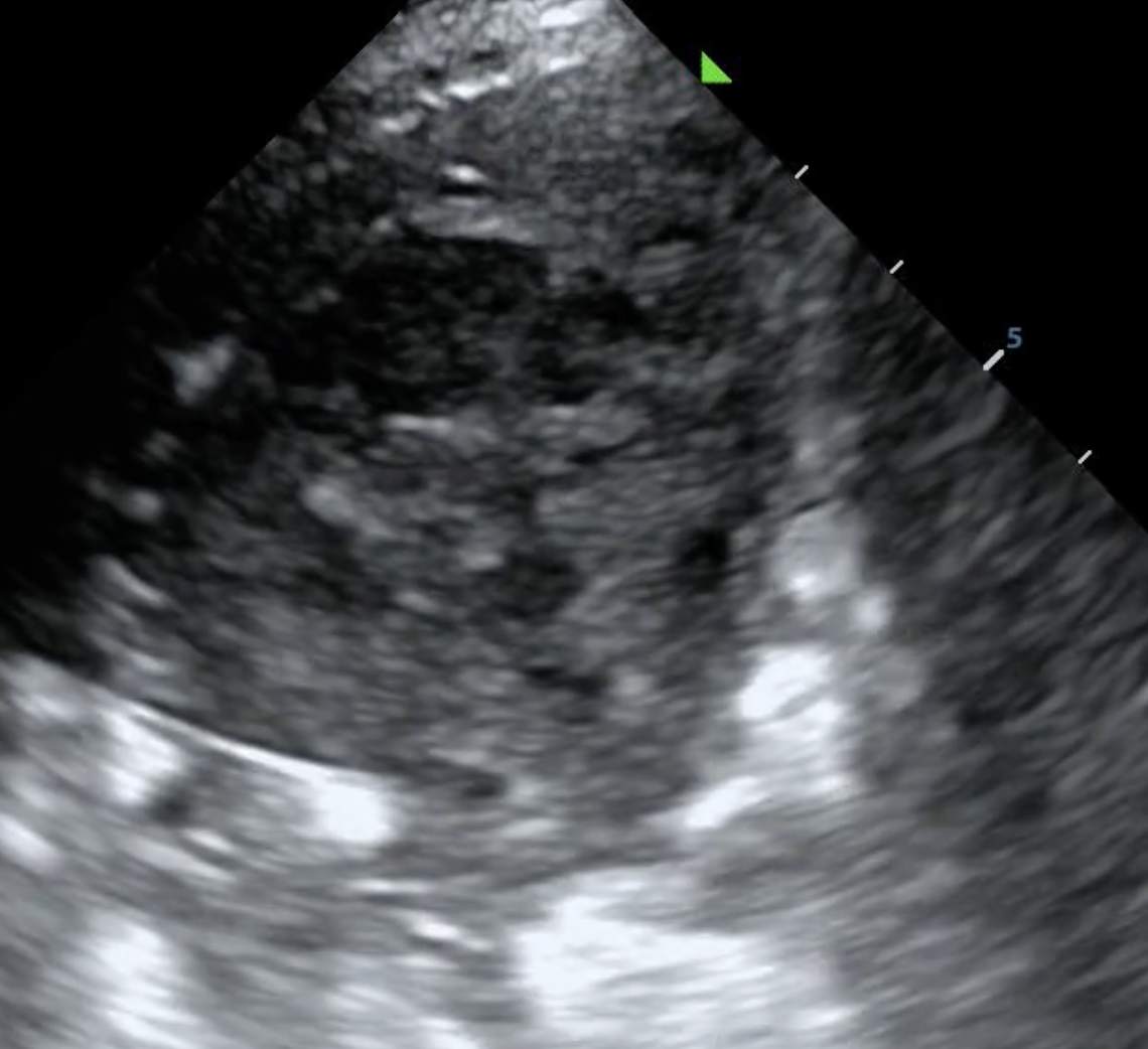 Consolidated lung with dark areas representing cavitary lesions