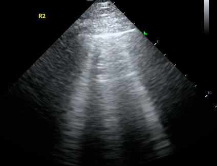 Abnormal B line lung ultrasound pattern