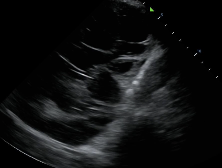 Septated pleural effusion