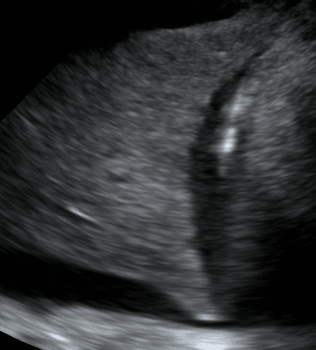 Hepatized lung